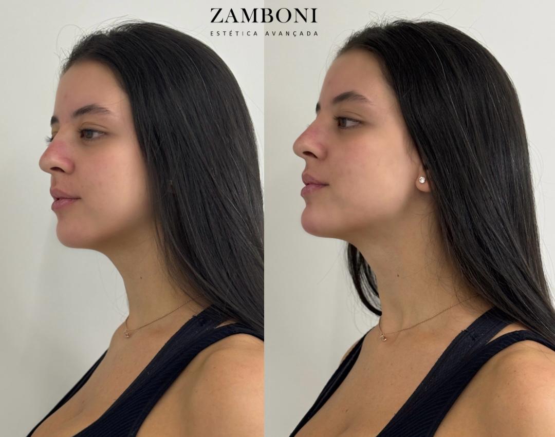 Resultado harmonização facial